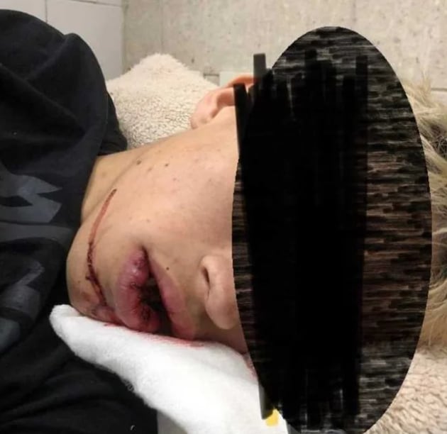 Brutal golpiza a un joven de 19 años a la salida de un boliche: le fracturaron la mandíbula
